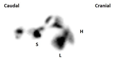Figure 3 – Composite image of a trans-splenic portal scintigraphy in a dog without PSS. Radiopharmaceutical uptake is seen only at the site of injection in the spleen (S) and in the liver (L), with no activity noted at the level of the heart (H) or rest of the body.