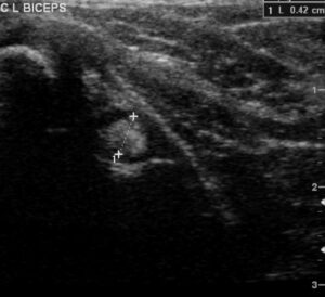 ultrasound-image-of-biceps-tendon