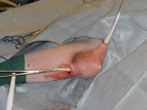 Figure 4B: Intraoperative placement of the 10mm flat drain.