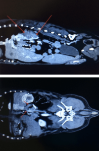 Figures 1 and 2: The two images here represent dorsal and sagittal views from CT scan of a patient with bilateral adrenomegaly. Ultrasound was concerning but not definitive for vena caval invasion. CT confirmed vena cava invasion.