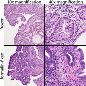 Figure 2: Canine rectal papillary adenoma, prepared using frozen section technique (upper two photomicrographs) and routine processing following formalin fixation (lower two images). Cellular detail is mildly reduced in frozen sections, but still adequate for diagnostic evaluation.