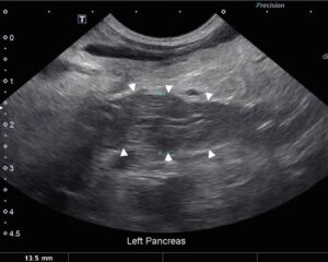 Image 3 – Severe pancreatitis in a cat. Note the moderately hypoechoic pancreas (white arrowheads) and hyperechoic peripancreatic fat.