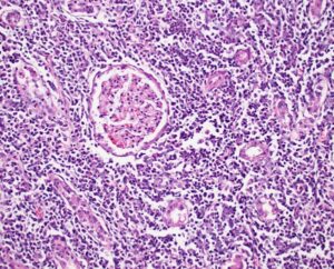 Photomicrograph of canine kidney with leptospirosis. Numerous leukocytes infiltrate the interstitium, separating and sometimes effacing renal tubules. This pattern is compatible with tubulointerstitial nephritis. An intact glomerulus is identified at the center of the image.