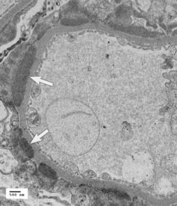 Fig 1. Transmission electron micrograph (15,000x) of a canine glomerular capillary loop demonstrating deposition of subepithelial deposits (arrows) consistent with immune complexes (Courtesy of Dr. Lees and Clubb, Texas Veterinary Renal Pathology Service).