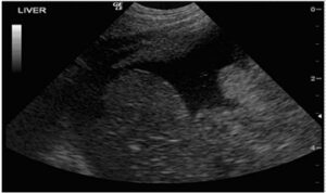 Fig 1 - A large volume of neoplastic effusion in a cat