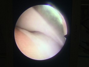 Figure 1: Arthroscopic image of an elbow joint documenting delineation between eroded cartilage in the medial compartment and more normal cartilage in the lateral compartment