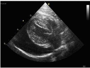 fig 4 - pericardial effusion