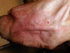 Figure 3: Postoperative view of the medial aspect of the pinna. The arrows denote the silhouette of the drain after the activated drain removes the fluid contents of the aural hematoma.
