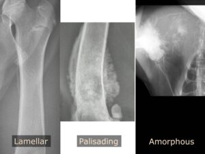 Image 5 – Ill defined or interrupted periosteal reactions. Lamellar reaction along the medial aspect of the proximal femur, characterized by linear mineralization parallel to the periosteum. Palisading (or columnar) reaction along the distal femur, characterized by linear mineralization perpendicular to the periosteum. Amorphous periosteal reaction associated with a highly aggressive proximal humerus lesion. All lesions were osteosarcoma.