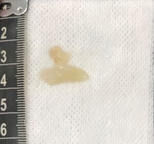 Discharge flushed from the bulla after a myringotomy in a PSOM-affected patient