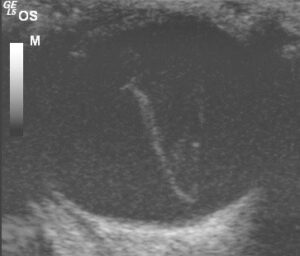 Figure 5 – Ocular ultrasound of an eye with retinal detachment (the retina is the V-shaped structure in the vitreous). This eye was not a candidate for surgery. (This oblique view of the globe does not clearly show the lens; the cornea is at the top of the image.)